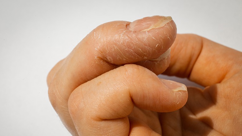 closeup of hand with deep grooves in nails