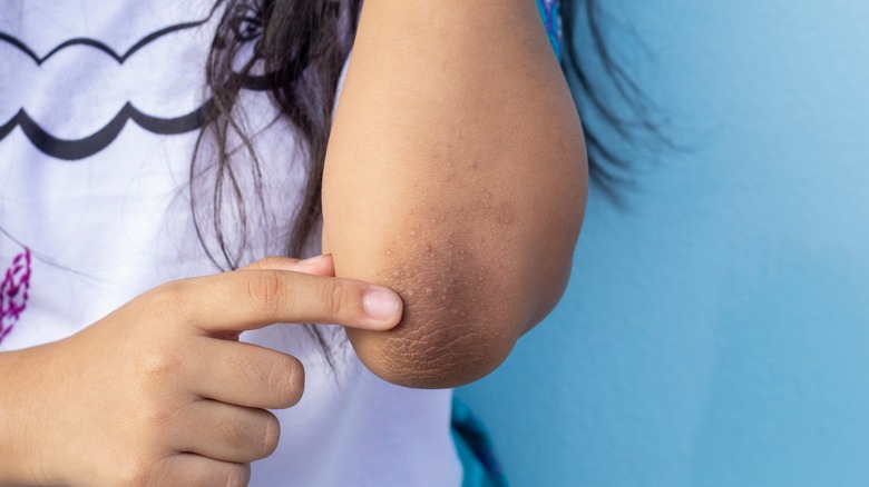 Touching dry elbow