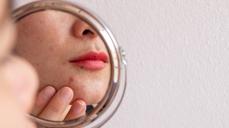 Close up of woman's acne