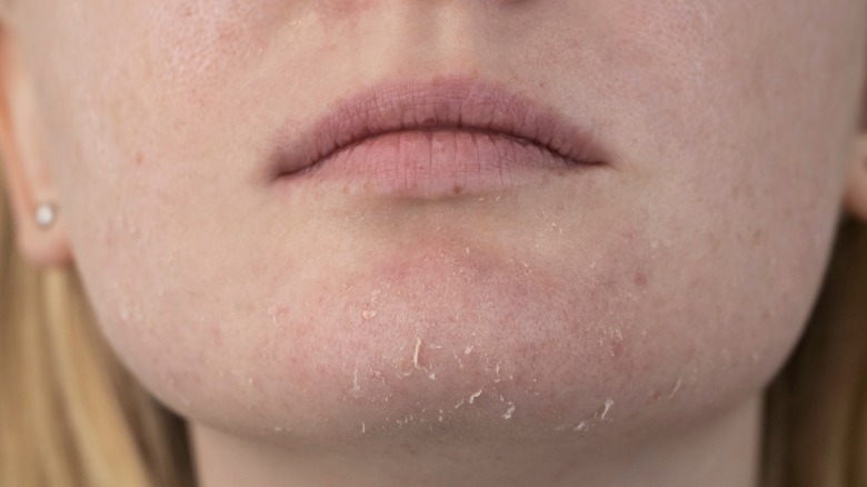 Woman with dry skin