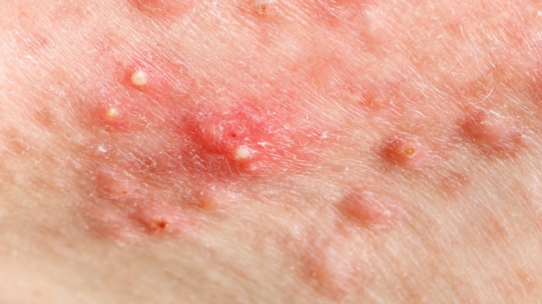 Skin with whiteheads