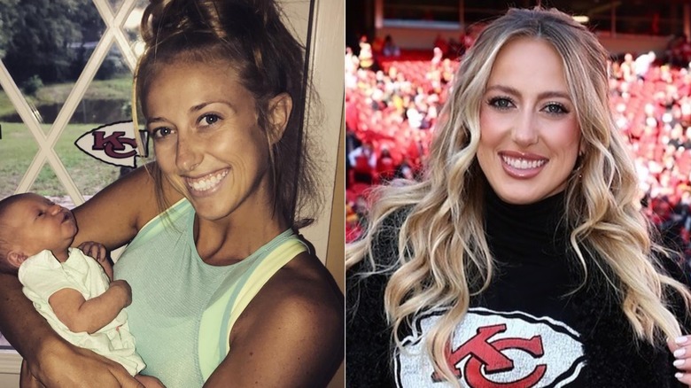 Brittany Mahomes before and after lip fillers, side by side photos