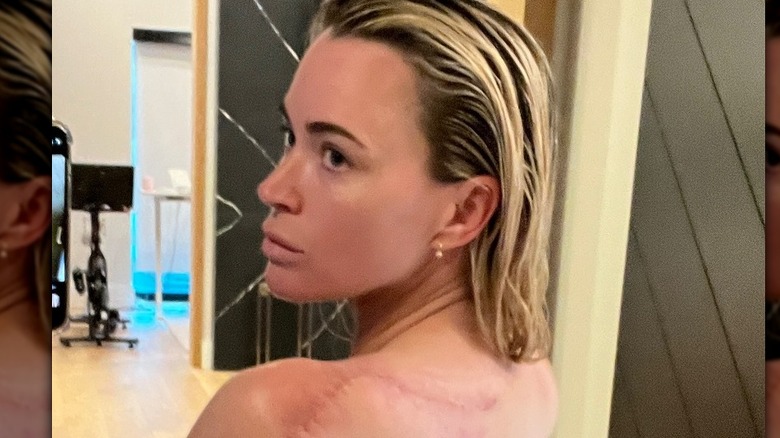 Teddi Mellencamp showing her scar