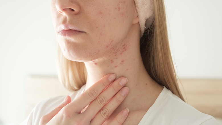 Woman with cystic acne