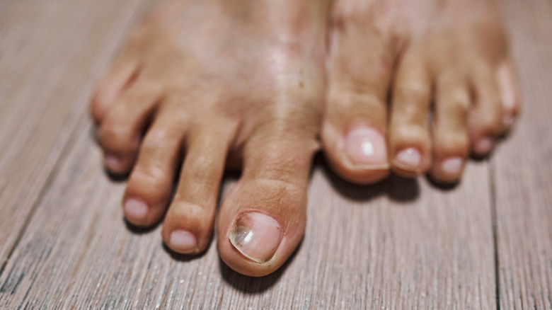 A close-up of a person's toe with a bruised toenail bed