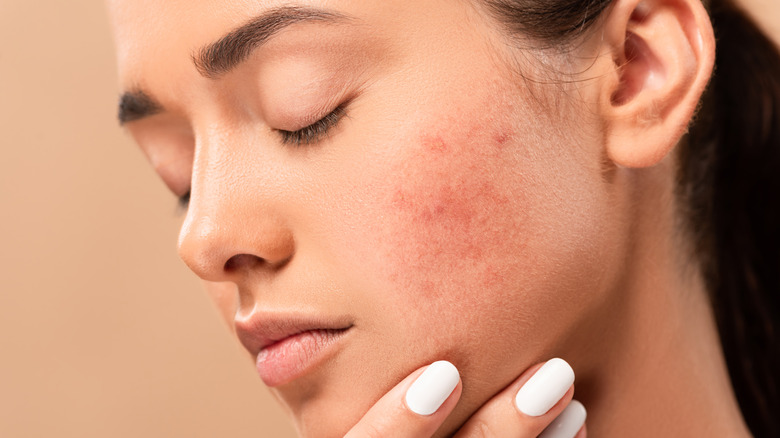 Woman with redness on face