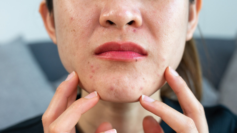 Chin blemishes