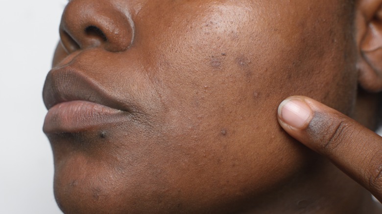 Woman with acne