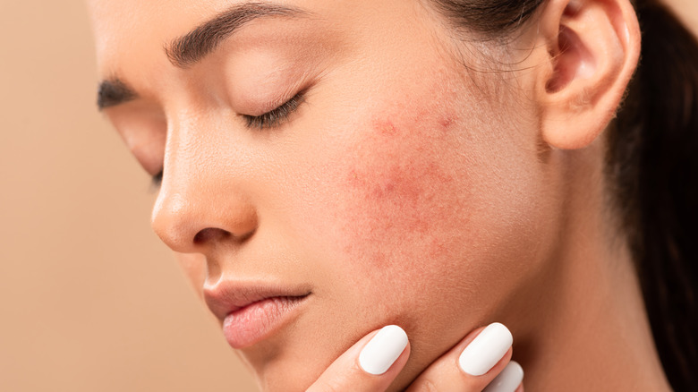 Woman with blemishes