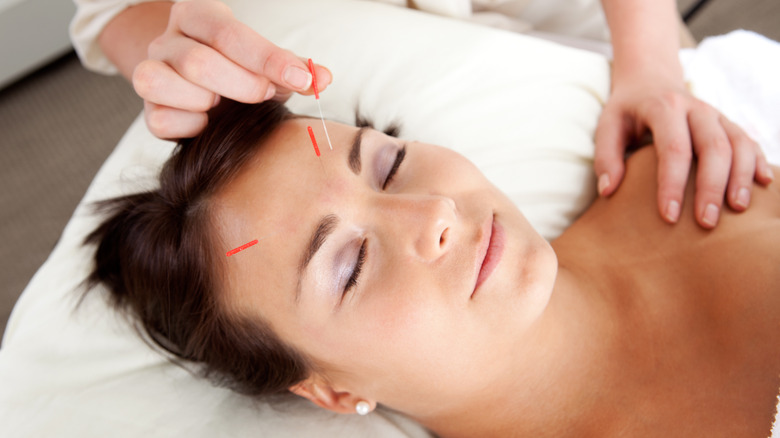 Woman getting facial acupuncture