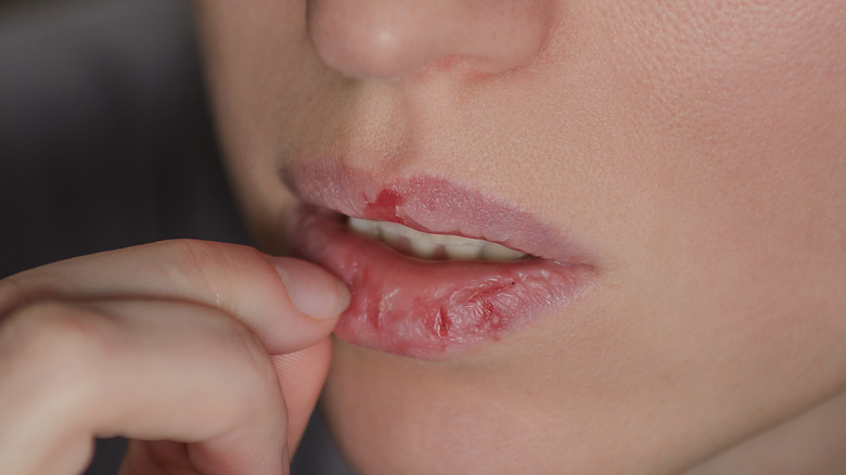 Peeling lip skin