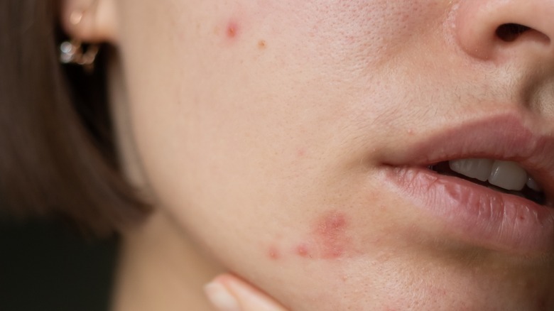 Chin acne