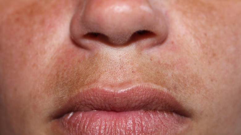 Melasma mustache