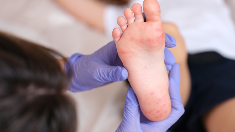 Doctor examining rashy foot