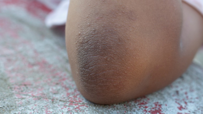 Dark patch on skin