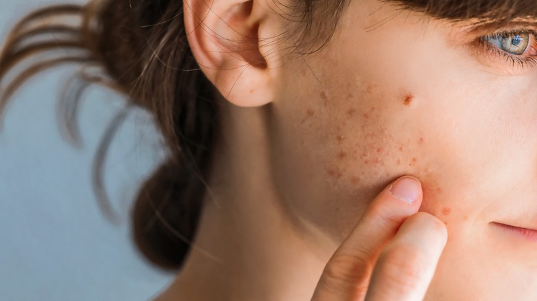 Facial acne