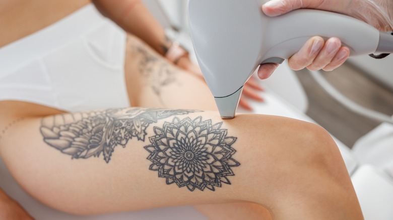 How laser hair removal affects tattoos  Australian Skin Clinics