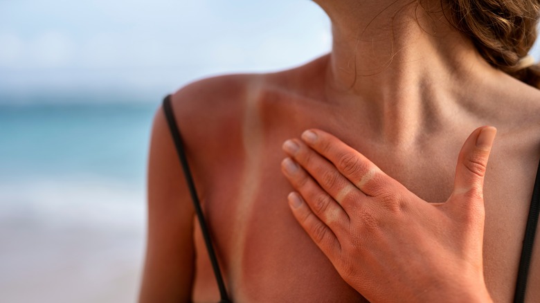 Person with a sunburn