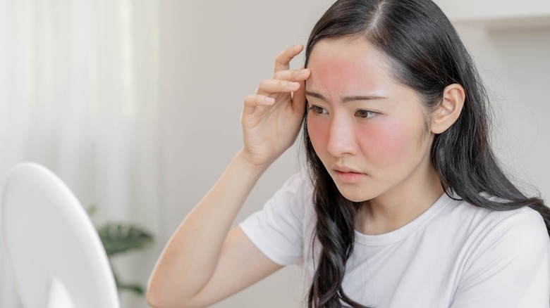 Woman with sunburn