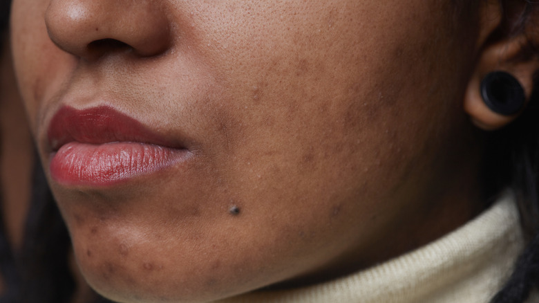Facial acne
