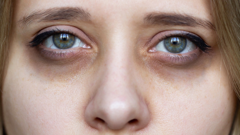 Dark eye circles