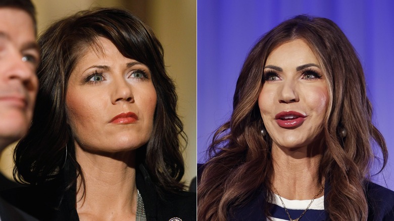 Kristi Noem in an old photo and a more updated one of Noem with bigger lips