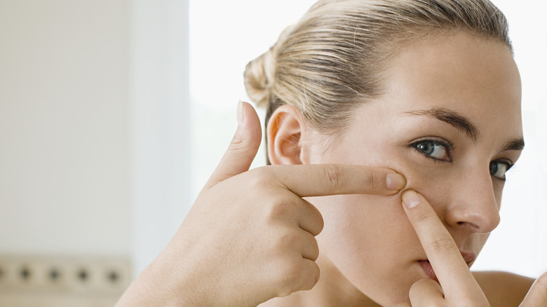 Woman with acne
