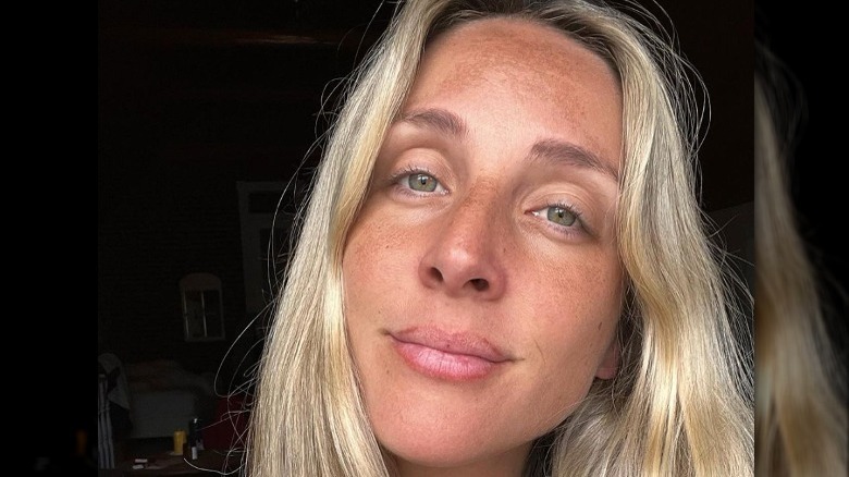Woman with melasma 