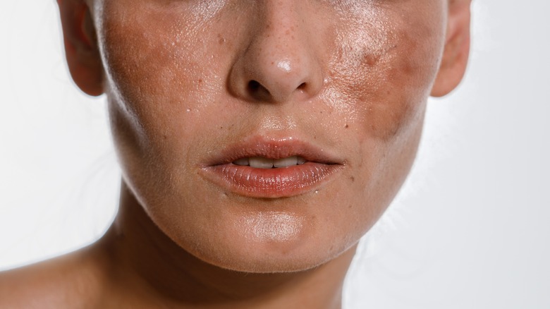 Woman with melasma 