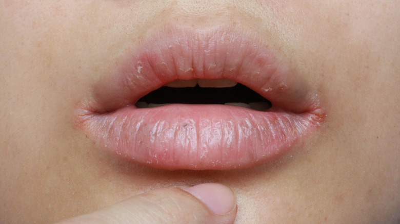 Cracked lip corners