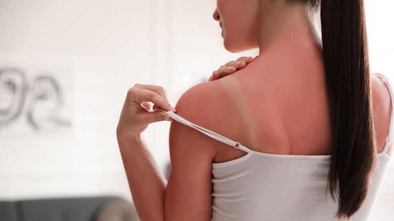 woman with sunburned back 