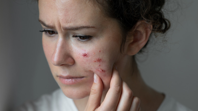 Oily skin issues