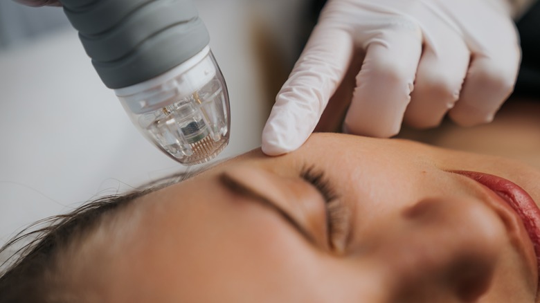 Woman getting microneedled