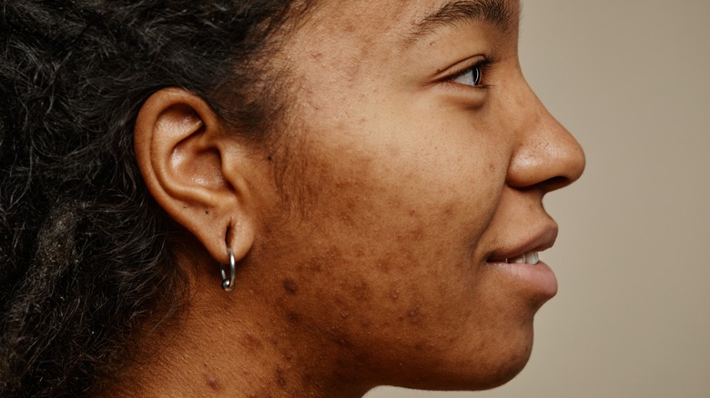 Facial acne scars