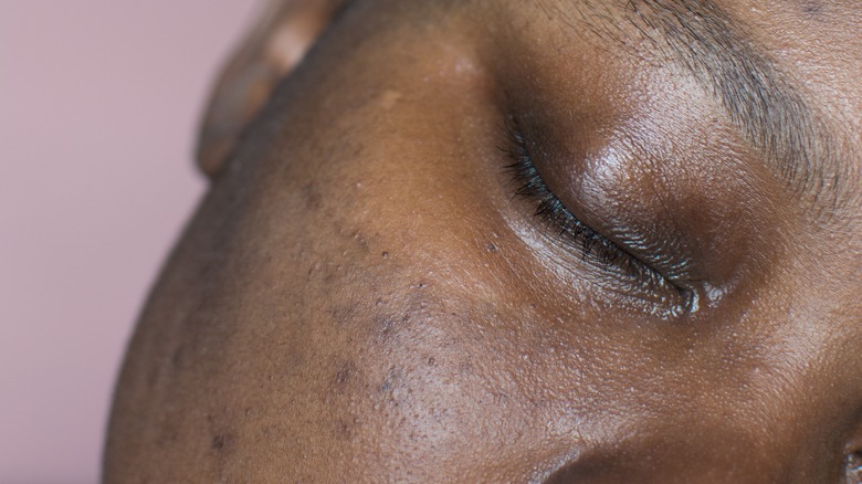 Woman with hyperpigmentation 
