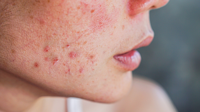 Woman with irritated and scabby skin