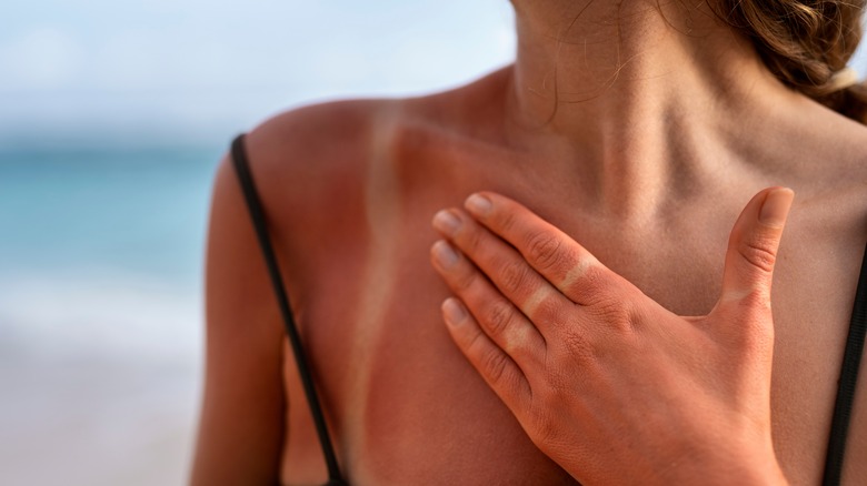 sunburned skin
