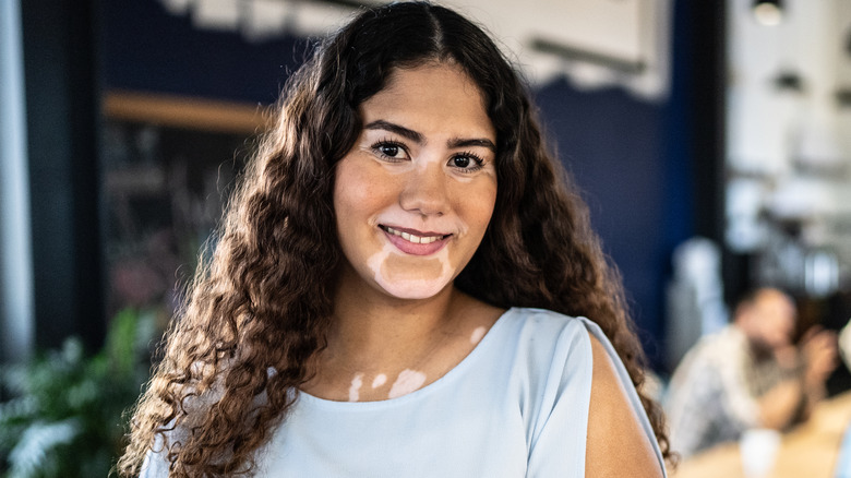 Woman with vitiligo