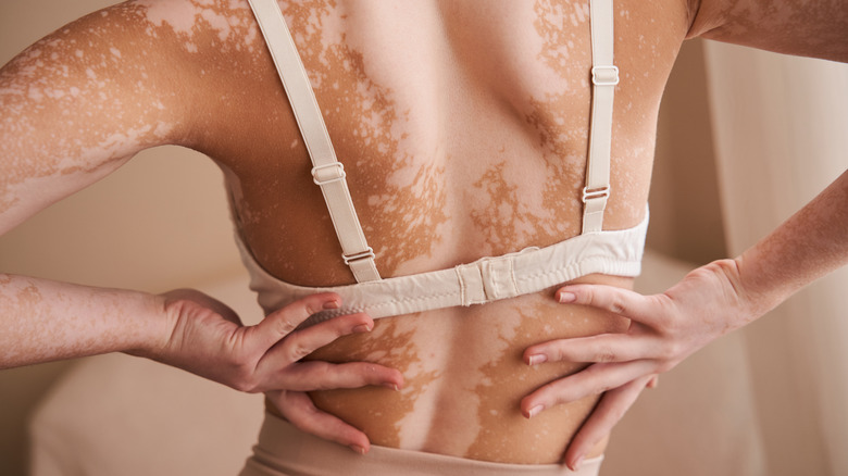 Back with vitiligo