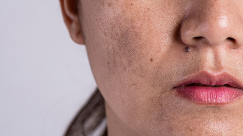 Woman with oily skin