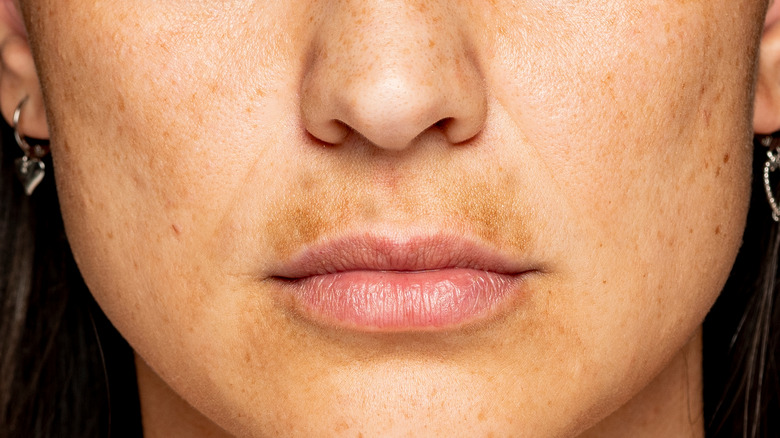 Discolored melasma skin