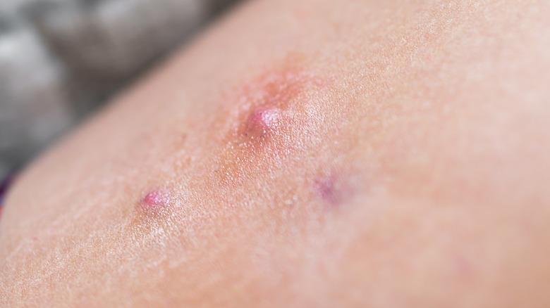 Close-up of swollen, red lump