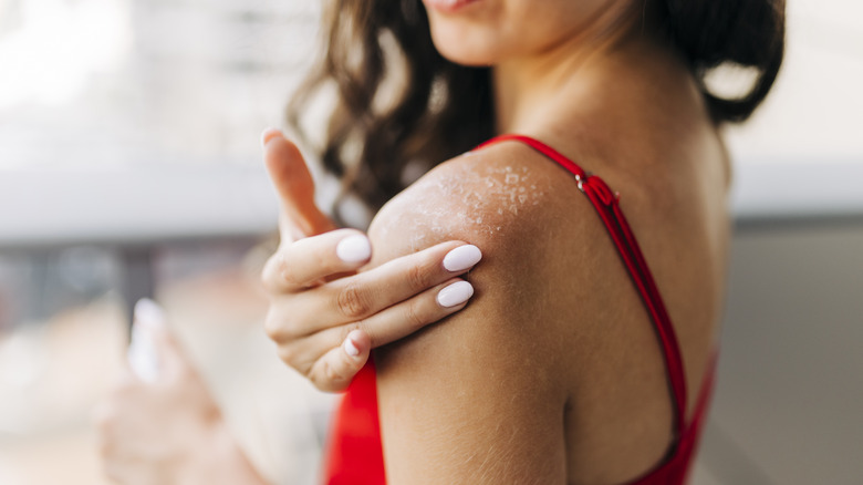 woman soothes sunburn