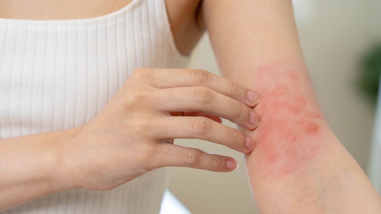 Woman with irritated arm