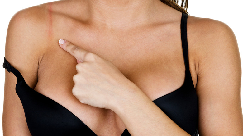 Bra strap irritation 