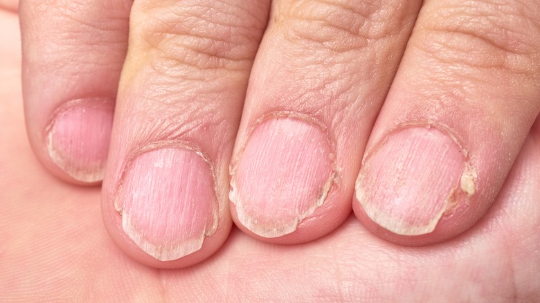 Damaged nails