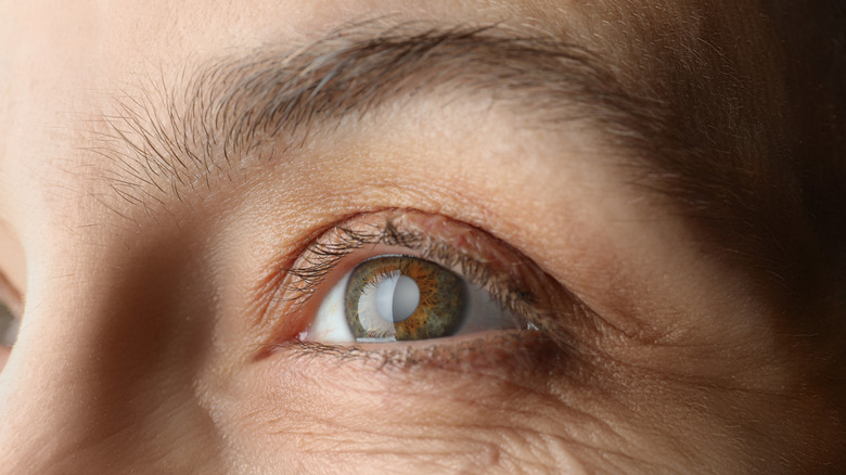 eye with cataract