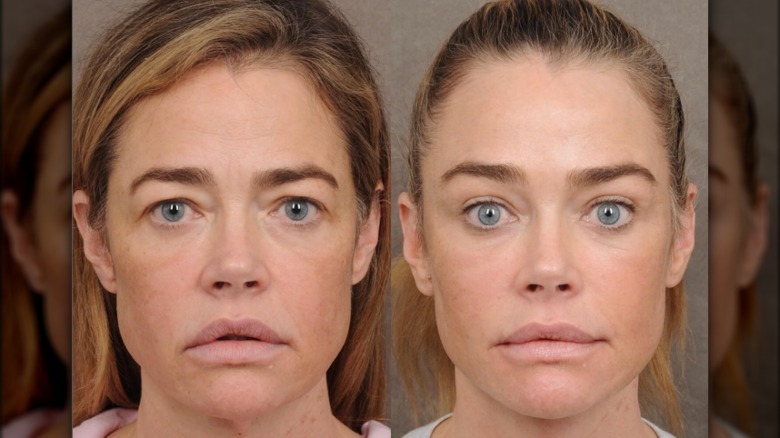 Denise Richards' before and after facelift photos