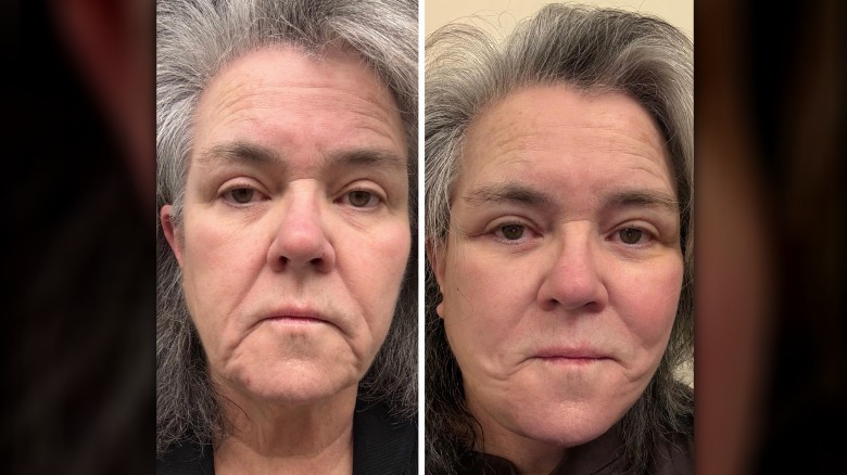 Rosie O'Donnell before-and-after photos after her facelift