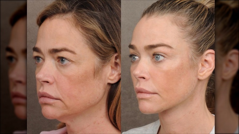 Denise Richards' before and after facelift photos